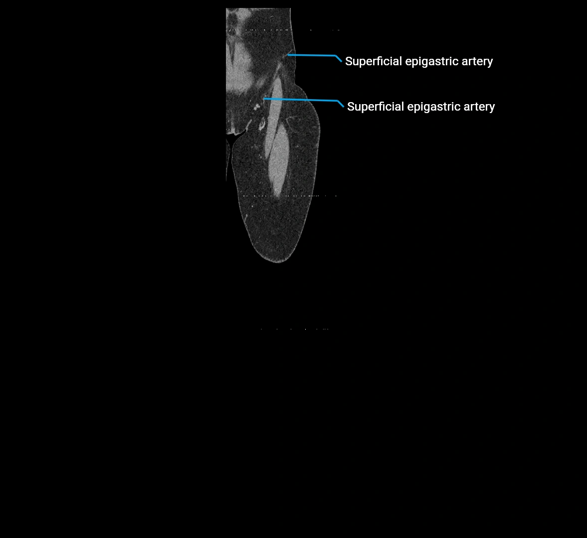 CTA lower limb coronal cross sectional anatomy labelled image _4 (2).webp